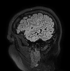 Cerebral arteriovenous malformation (Radiopaedia 74411-85654 Sagittal FLAIR 16).jpg