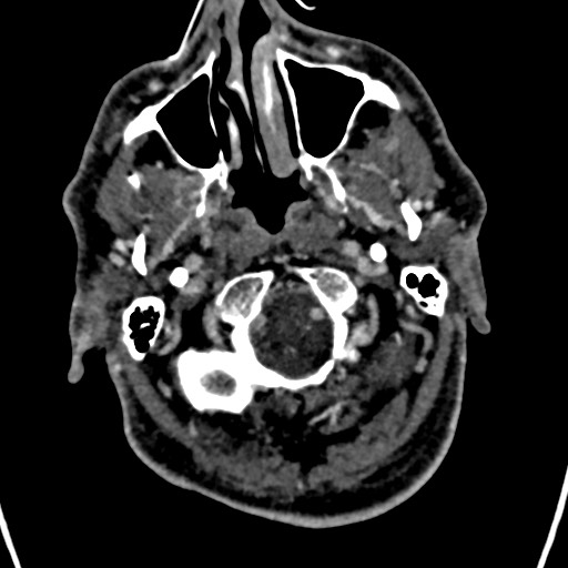 Cerebral arteriovenous malformation (Radiopaedia 78188-90746 Axial C+ delayed 13).jpg