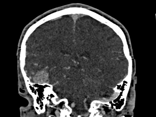 Cerebral arteriovenous malformation (Radiopaedia 78188-90746 Coronal C+ delayed 77).jpg