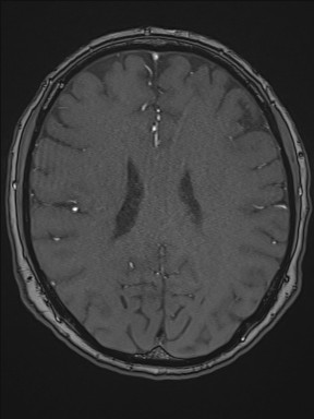 File:Cerebral arteriovenous malformation (Radiopaedia 84015-99245 Axial TOF 149).jpg