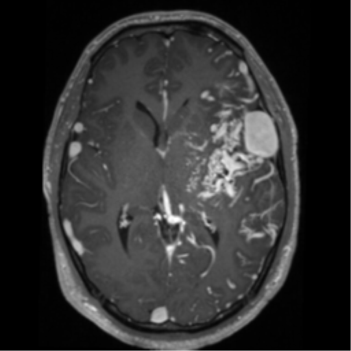 Cerebral arteriovenous malformation - huge (Radiopaedia 35734-37272 Axial T1 C+ 35).png