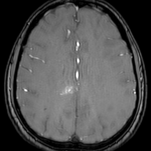 Cerebral arteriovenous malformation at posterior body of corpus callosum (Radiopaedia 74111-84925 Axial MRA 149).jpg