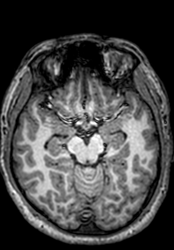 Cerebral arteriovenous malformation at posterior body of corpus callosum (Radiopaedia 74111-84925 Axial T1 188).jpg
