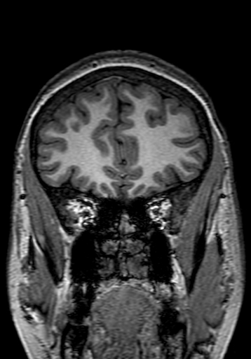 Cerebral arteriovenous malformation at posterior body of corpus callosum (Radiopaedia 74111-84925 Coronal T1 59).jpg