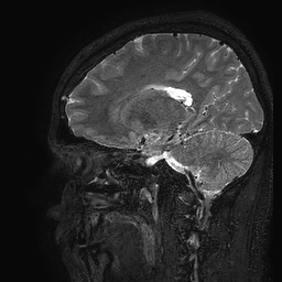 Cerebral arteriovenous malformation at posterior body of corpus callosum (Radiopaedia 74111-84925 Sagittal T2 48).jpg
