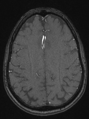 Cerebral arteriovenous malformation with hemorrhage (Radiopaedia 34422-35737 Axial MRA 60).png