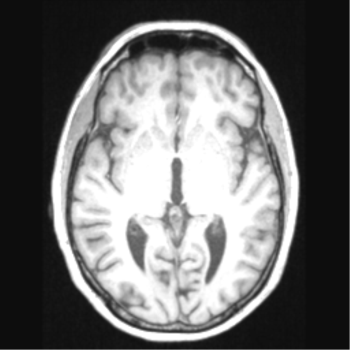 Cerebral arteriovenous malformation with hemorrhage (Radiopaedia 34422-35737 Axial T1 38).png
