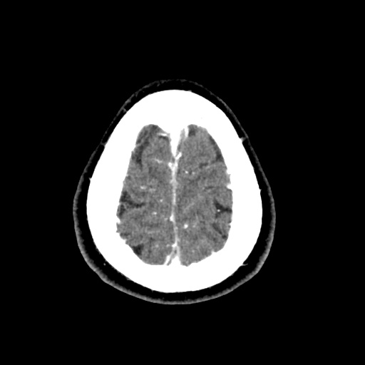 Cerebral arteriovenous malformation with lobar hemorrhage (Radiopaedia 35598-57216 A 56).jpg