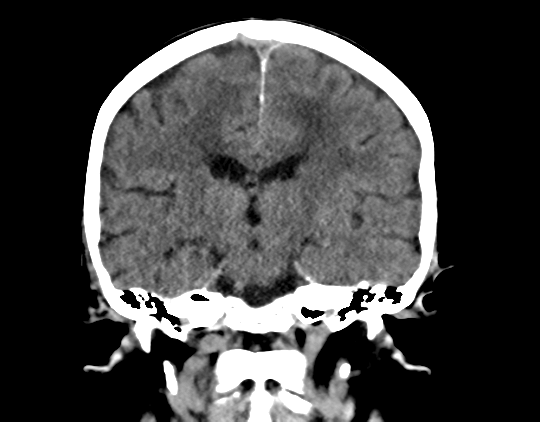 Cerebral arteriovenous malformation with lobar hemorrhage (Radiopaedia 44725-48510 Coronal non-contrast 28).png