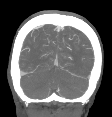 Cerebral arteriovenous malformation with lobar hemorrhage (Radiopaedia 44725-48511 B 47).png