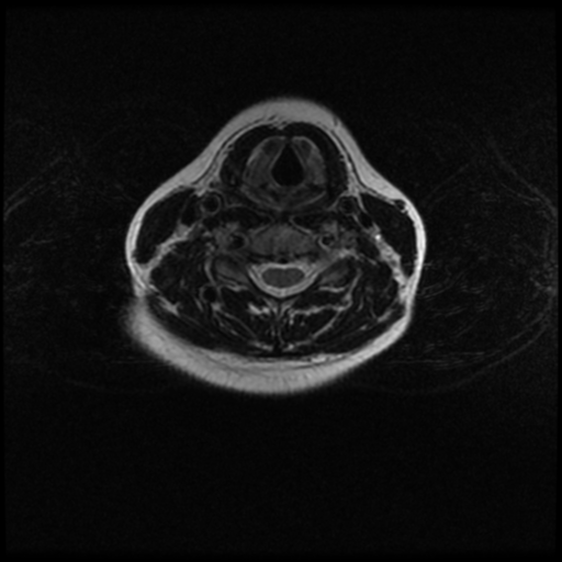 File:Cerebral autosomal dominant arteriopathy with subcortical infarcts and leukoencephalopathy (CADASIL) (Radiopaedia 41018-43763 Ax T2 C2-T1 15).png