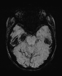 Cerebral cavernous venous malformation (Radiopaedia 70008-80021 Axial SWI 23).jpg