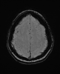Cerebral cavernous venous malformation (Radiopaedia 70008-80021 I 61).jpg