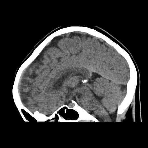 File:Cerebral cavernous venous malformation (Radiopaedia 70008-80022 C 29).jpg