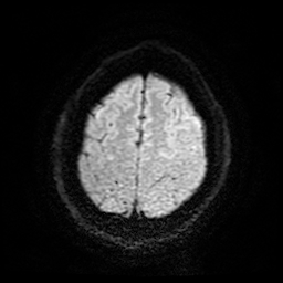 Cerebral cavernous venous malformation (Zabramski type II) (Radiopaedia 85511-101198 Axial DWI 26).jpg