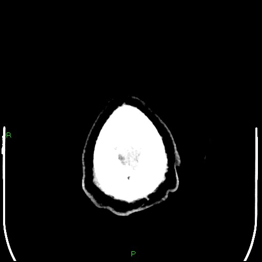 Cerebral contusions (Radiopaedia 33868-35039 Axial non-contrast 216).jpg