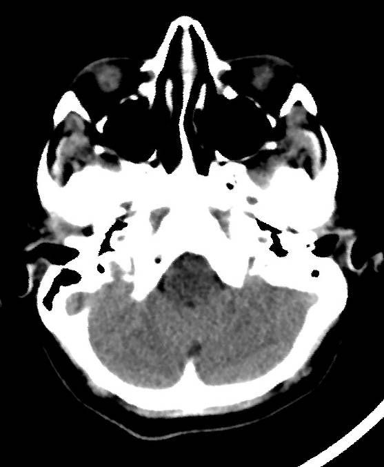 Cerebral edema due to severe hyponatremia (Radiopaedia 89826-106937 Axial non-contrast 15).jpg