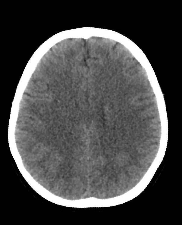 Cerebral edema due to severe hyponatremia (Radiopaedia 89826-106938 Axial non-contrast 67).jpg