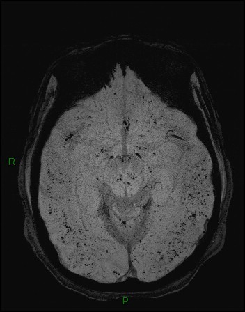 Cerebral fat embolism (Radiopaedia 35022-36525 Axial SWI 9).jpg