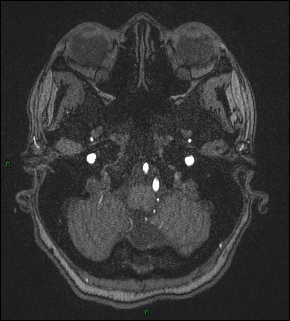 Cerebral fat embolism (Radiopaedia 35022-36525 Axial TOF 27).jpg