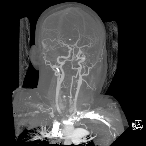 File:Cerebral hemorrhage secondary to arteriovenous malformation (Radiopaedia 33497-34571 A 22).png