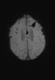 File:Cerebral hemorrhagic contusions- temporal evolution (Radiopaedia 40224-42757 Axial SWI 26).png
