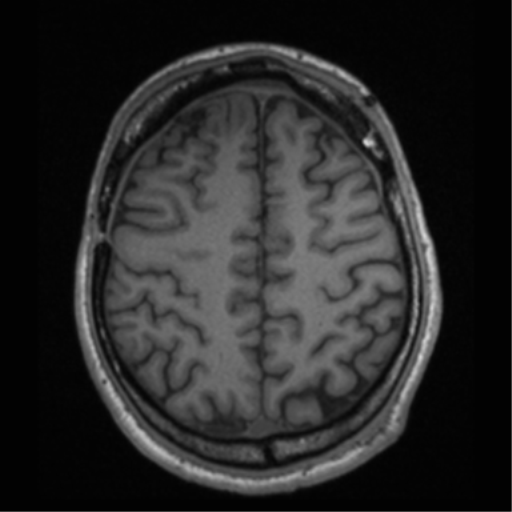 Cerebral hemorrhagic contusions- temporal evolution (Radiopaedia 40224-42757 Axial T1 59).png