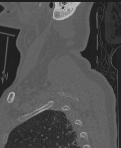 Cerebral hemorrhagic contusions and cervical spine fractures (Radiopaedia 32865-33841 Sagittal bone window 93).jpg