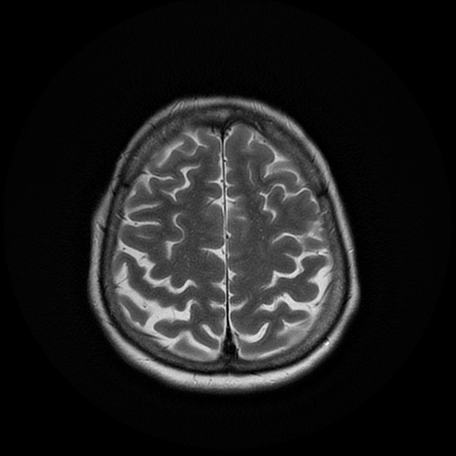 File:Cerebral metastases - melanoma (Radiopaedia 80972-94522 Axial T2 24).jpg