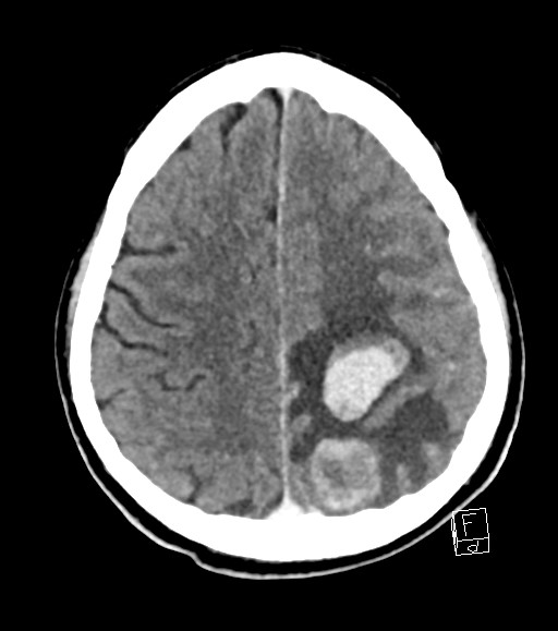 Cerebral metastases - testicular choriocarcinoma (Radiopaedia 84486-99855 Axial C+ delayed 18).jpg