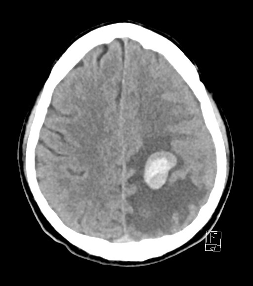 Cerebral metastases - testicular choriocarcinoma (Radiopaedia 84486-99855 Axial non-contrast 19).jpg
