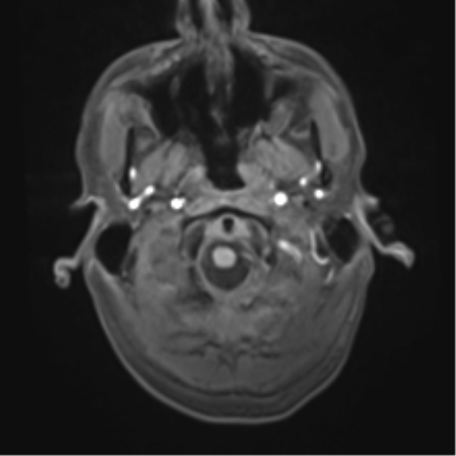 Cerebral metastasis - melanoma (Radiopaedia 54718-60954 Axial T1 5).png
