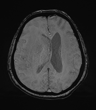 Cerebral metastasis to basal ganglia (Radiopaedia 81568-95413 Axial SWI 54).png