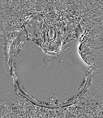 Cerebral metastasis to basal ganglia (Radiopaedia 81568-95413 Axial SWI phase 29).png