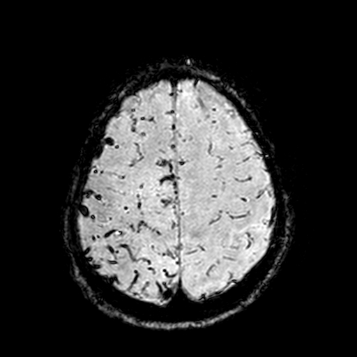 Cerebral parenchymal arteriovenous malformation (Radiopaedia 27280-27456 Axial SWI 99).jpg