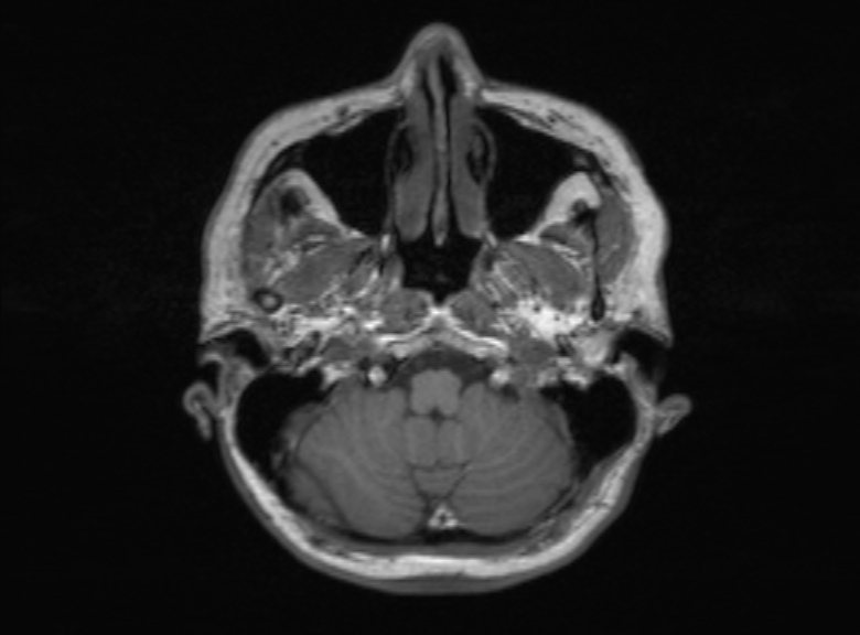 Cerebral ring enhancing lesions - cerebral metastases (Radiopaedia 44922-48817 Axial T1 332).jpg