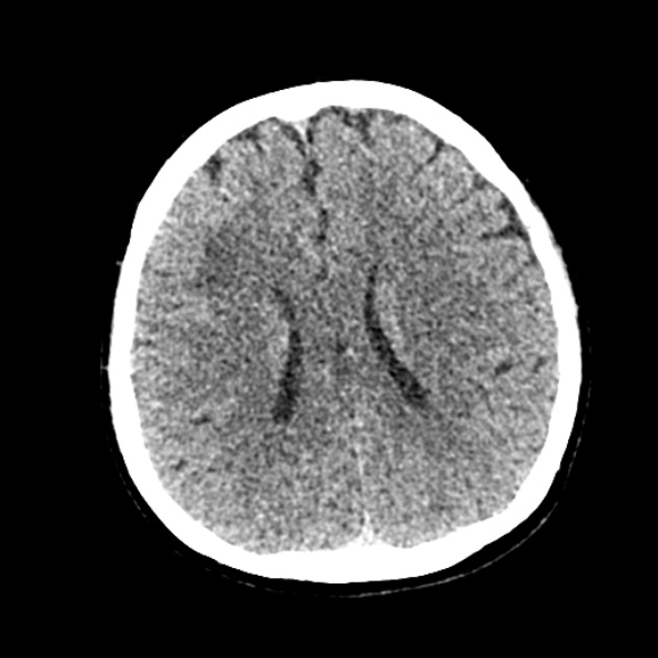Cerebral ring enhancing lesions - cerebral metastases (Radiopaedia 44922-48818 Axial non-contrast 47).jpg