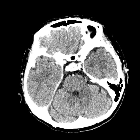 Cerebral ring enhancing lesions - cerebral metastases (Radiopaedia 44922-48818 B 96).jpg