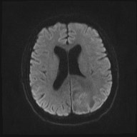 File:Cerebral toxoplasmosis (Radiopaedia 43956-47461 Axial DWI 13).jpg