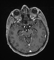 Cerebral toxoplasmosis (Radiopaedia 43956-47461 Axial T1 C+ 28).jpg