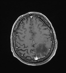 Cerebral toxoplasmosis (Radiopaedia 43956-47461 Axial T1 C+ 61).jpg