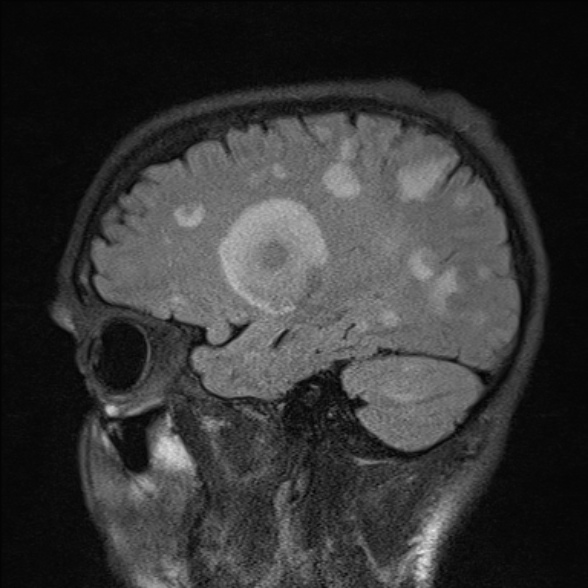File:Cerebral toxoplasmosis (Radiopaedia 53993-60132 Sagittal FLAIR 20).jpg