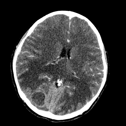 Cerebral tuberculosis with dural sinus invasion (Radiopaedia 60353-68019 Axial C+ delayed 36).jpg
