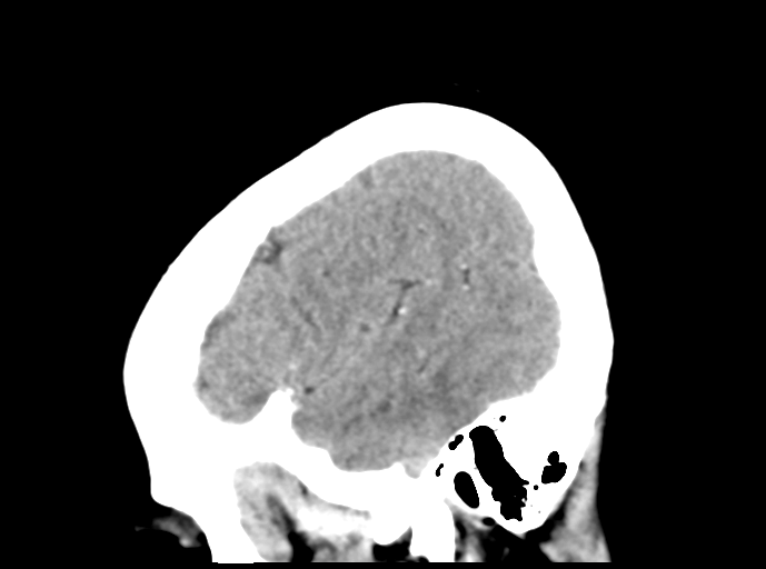 Cerebral venous hemorrhagic infarction (Radiopaedia 57576-64538 Sagittal C+ 44).png