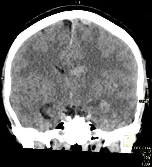 Cerebral venous sinus thrombosis (Radiopaedia 91329-108965 Coronal non-contrast 28).jpg