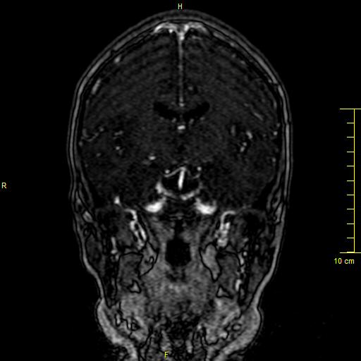 File:Cerebral venous thrombosis (Radiopaedia 23288-23351 MRV 71).JPG