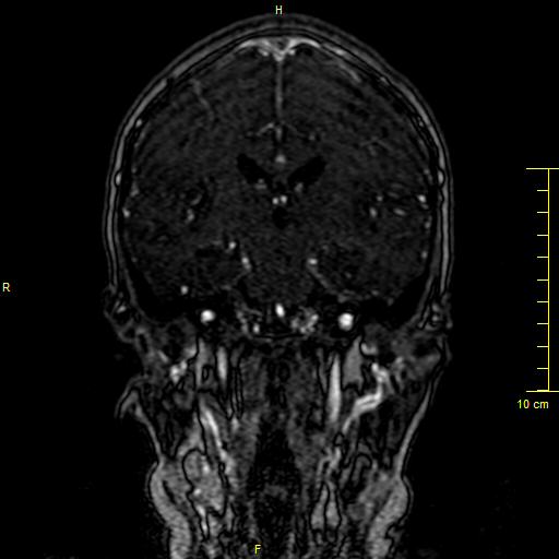 Cerebral venous thrombosis (Radiopaedia 23288-23351 MRV 81).JPG