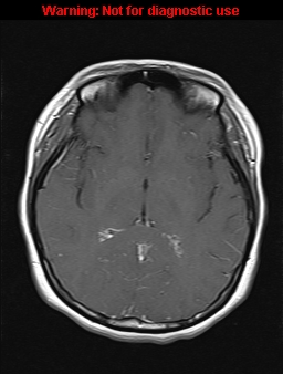 File:Cerebral venous thrombosis (Radiopaedia 37224-39208 Axial T1 C+ 11).jpg