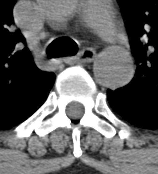 Cervical canal stenosis due to ossification of the posterior longitudinal ligament (Radiopaedia 47260-51823 Axial non-contrast 81).png