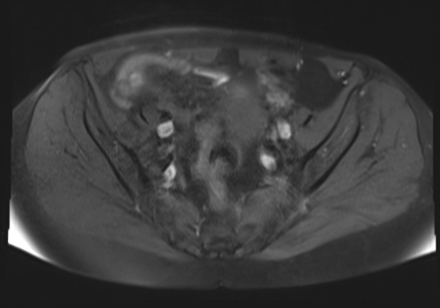 File:Cervical carcinoma (Radiopaedia 88312-104943 Axial T1 fat sat 9).jpg